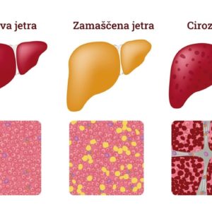 Zamaščenost jeter – ali se to tiče tudi vas?